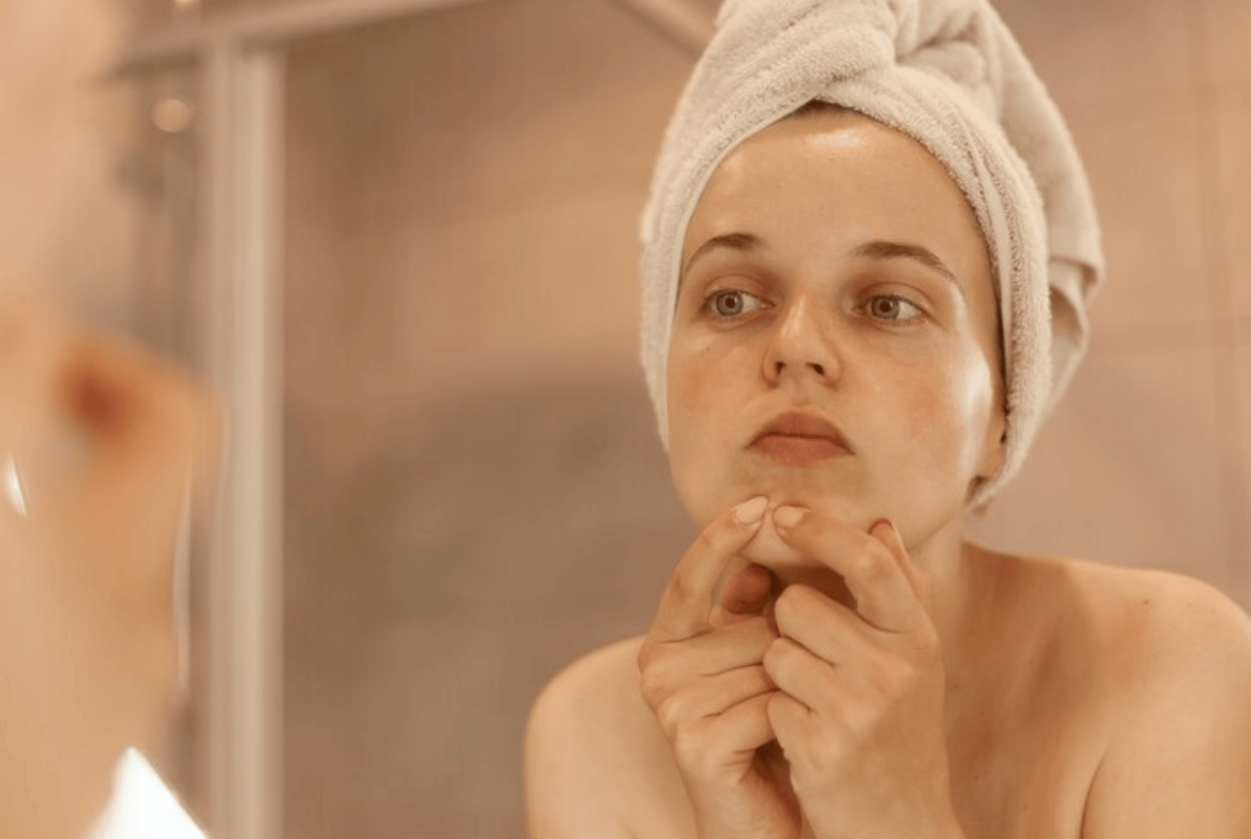 Dicas de como evitar acnes